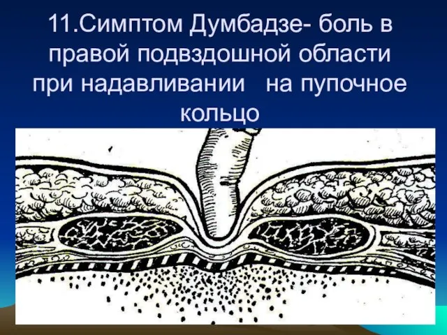 11.Симптом Думбадзе- боль в правой подвздошной области при надавливании на пупочное кольцо