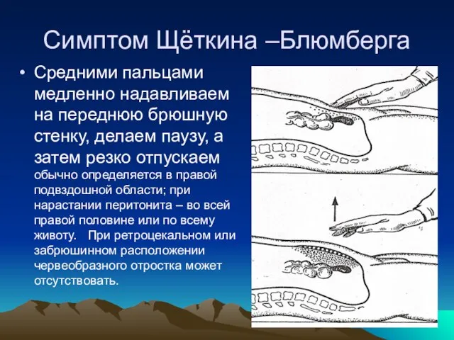 Симптом Щёткина –Блюмберга Средними пальцами медленно надавливаем на переднюю брюшную стенку,