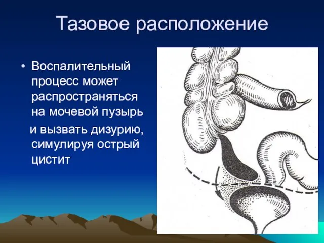 Тазовое расположение Воспалительный процесс может распространяться на мочевой пузырь и вызвать дизурию, симулируя острый цистит