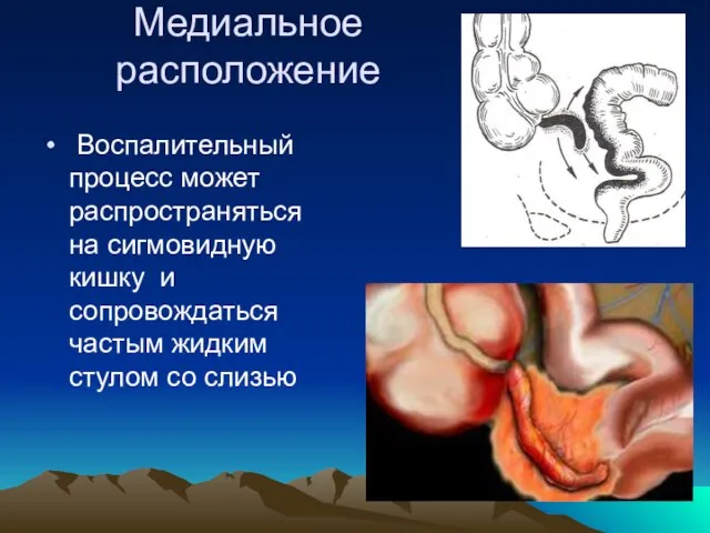 Медиальное расположение Воспалительный процесс может распространяться на сигмовидную кишку и сопровождаться частым жидким стулом со слизью