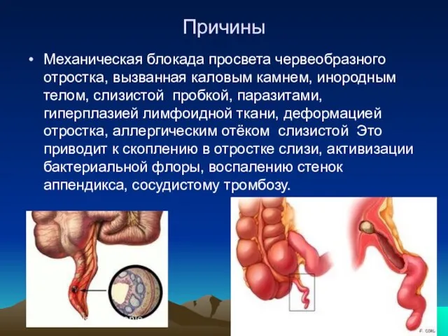 Причины Механическая блокада просвета червеобразного отростка, вызванная каловым камнем, инородным телом,