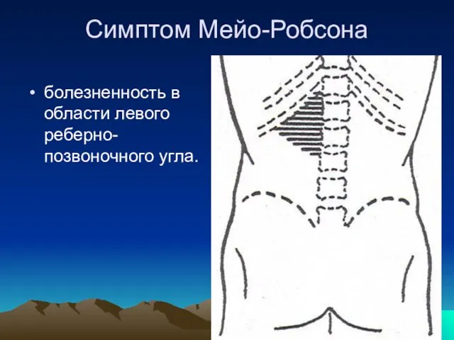 Симптом Мейо-Робсона болезненность в области левого реберно-позвоночного угла.