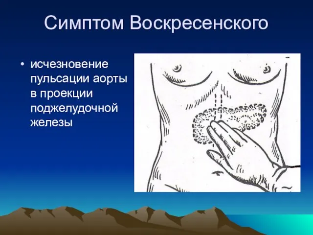 Симптом Воскресенского исчезновение пульсации аорты в проекции поджелудочной железы