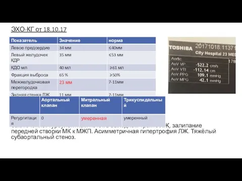 ЭХО-КГ от 18.10.17 Заключение: турбулентный поток в выходном тракте ЛЖ, залипание