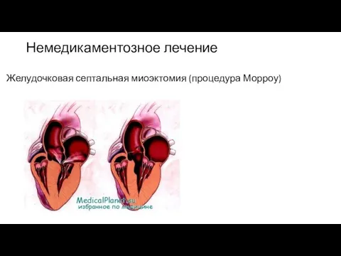 Немедикаментозное лечение Желудочковая септальная миоэктомия (процедура Морроу)