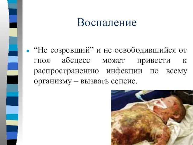 Воспаление “Не созревший” и не освободившийся от гноя абсцесс может привести