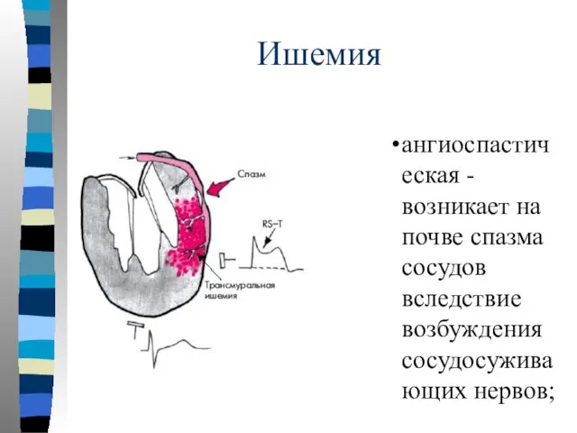 Ишемия ангиоспастическая - возникает на почве спазма сосудов вследствие возбуждения сосудосуживающих нервов;