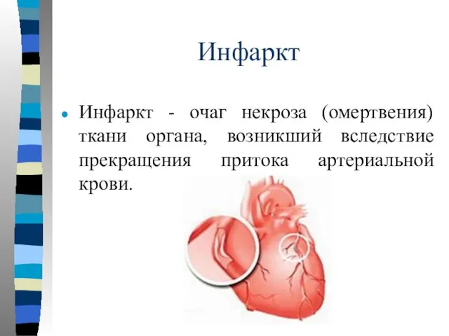 Инфаркт Инфаркт - очаг некроза (омертвения) ткани органа, возникший вследствие прекращения притока артериальной крови.