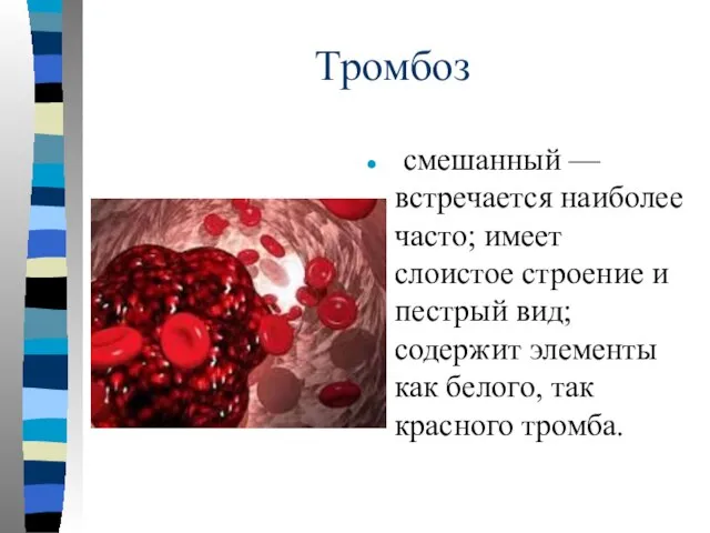 Тромбоз смешанный — встречается наиболее часто; имеет слоистое строение и пестрый