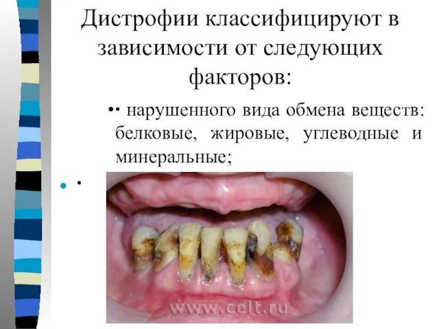 Дистрофии классифицируют в зависимости от следующих факторов: ∙ нарушенного вида обмена