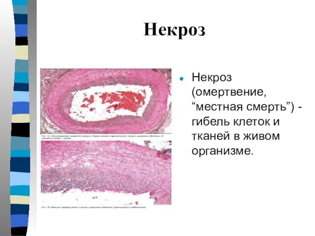 Некроз Некроз (омертвение, “местная смерть”) - гибель клеток и тканей в живом организме.