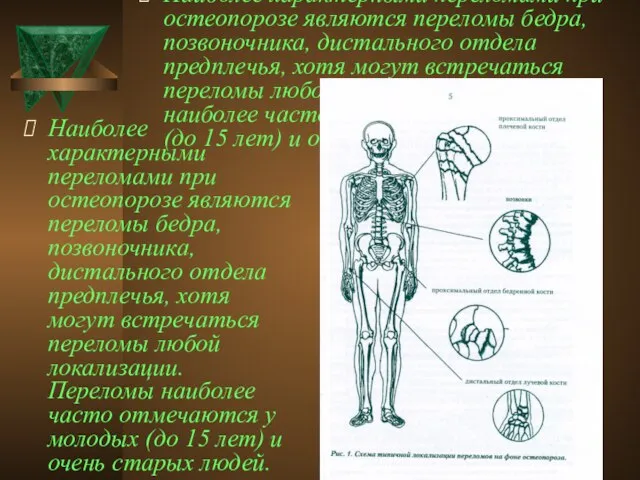 Наиболее характерными переломами при остеопорозе являются переломы бедра, позвоночника, дистального отдела