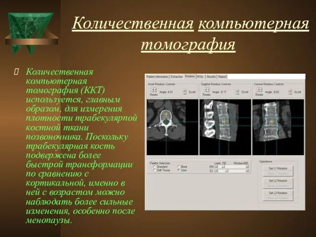 Количественная компьютерная томография Количественная компьютерная томография (ККТ) используется, главным образом, для