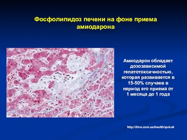 Фосфолипидоз печени на фоне приема амиодарона Амиодарон обладает дозозависимой гепатотоксичностью, которая