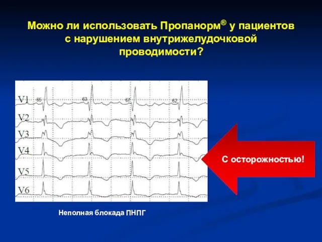 Можно ли использовать Пропанорм® у пациентов с нарушением внутрижелудочковой проводимости? Неполная блокада ПНПГ С осторожностью!