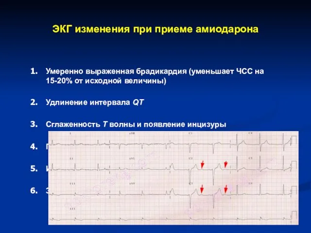 ЭКГ изменения при приеме амиодарона Умеренно выраженная брадикардия (уменьшает ЧСС на