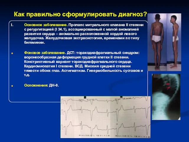 Как правильно сформулировать диагноз? Основное заболевание. Пролапс митрального клапана II степени