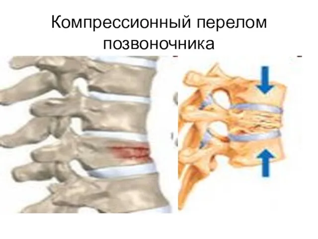 Компрессионный перелом позвоночника