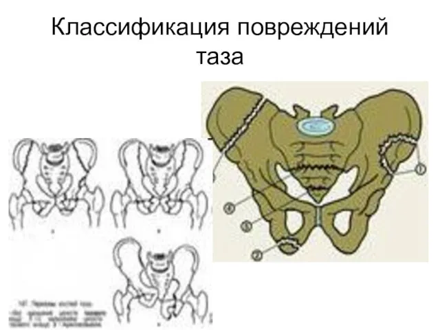 Классификация повреждений таза