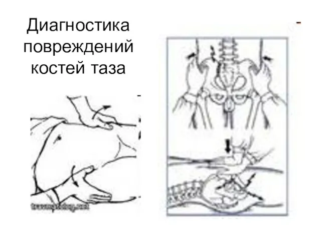 Диагностика повреждений костей таза