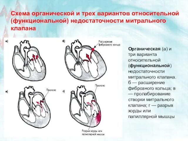 Схема органической и трех вариантов относительной (функциональной) недостаточности митрального клапана Органическая