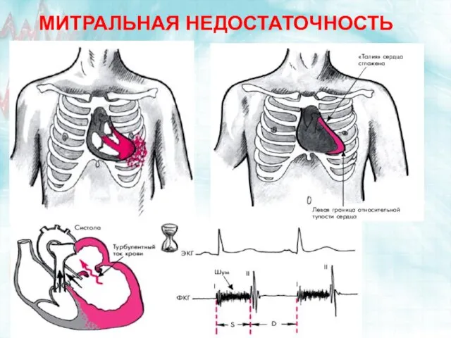 МИТРАЛЬНАЯ НЕДОСТАТОЧНОСТЬ