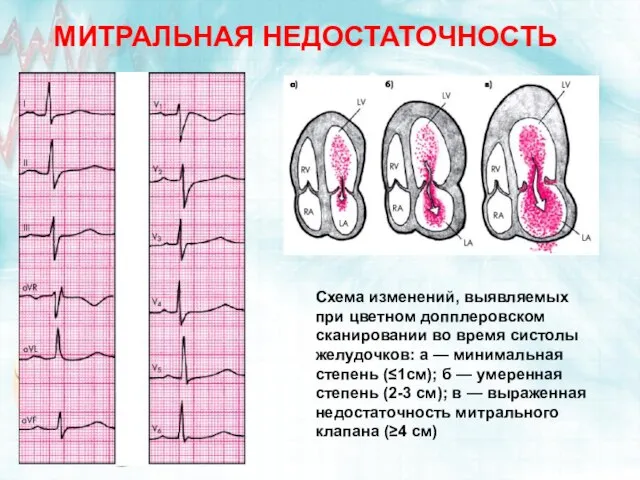 МИТРАЛЬНАЯ НЕДОСТАТОЧНОСТЬ Схема изменений, выявляемых при цветном допплеровском сканировании во время