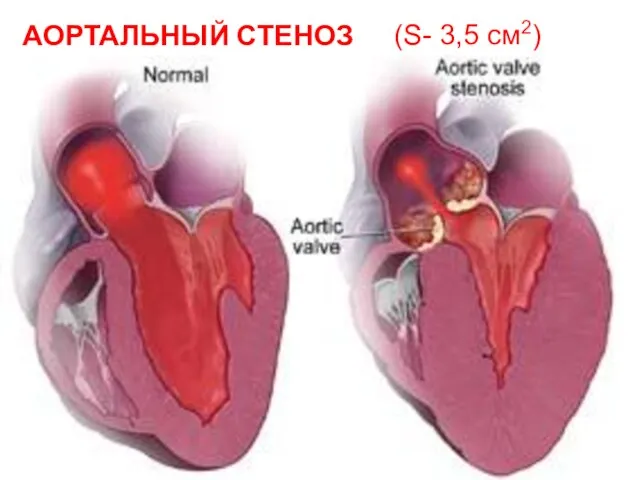 (S- 3,5 см2) АОРТАЛЬНЫЙ СТЕНОЗ