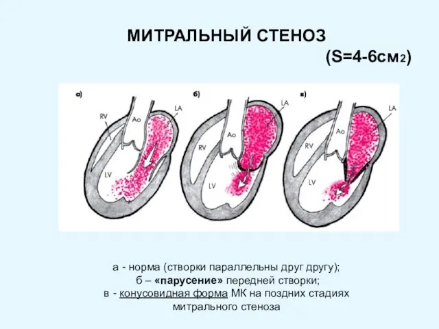 МИТРАЛЬНЫЙ СТЕНОЗ (S=4-6см2) а - норма (створки параллельны друг другу); б