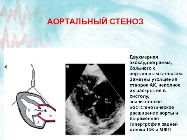 АОРТАЛЬНЫЙ СТЕНОЗ Двухмерная эхокардиограмма, больного с аортальным стенозом. Заметны утолщения створок