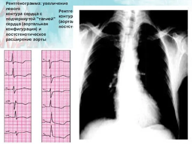 Рентгенограмма: увеличение левого контура сердца с подчеркнутой "талией" сердца (аортальная конфигурация)