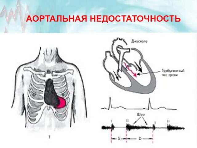 АОРТАЛЬНАЯ НЕДОСТАТОЧНОСТЬ