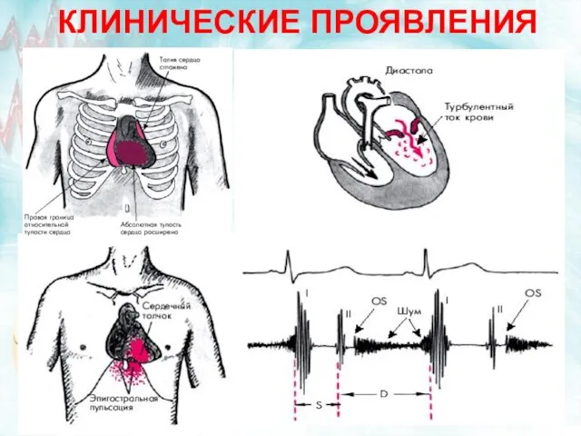 КЛИНИЧЕСКИЕ ПРОЯВЛЕНИЯ