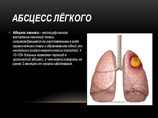 АБСЦЕСС ЛЁГКОГО Абсцесс легкого – неспецифическое воспаление легочной ткани, сопровождающееся ее