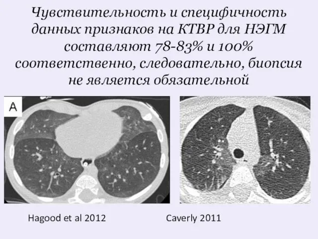 Чувствительность и специфичность данных признаков на КТВР для НЭГМ составляют 78-83%