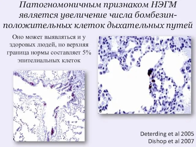 Патогномоничным признаком НЭГМ является увеличение числа бомбезин-положительных клеток дыхательных путей Оно