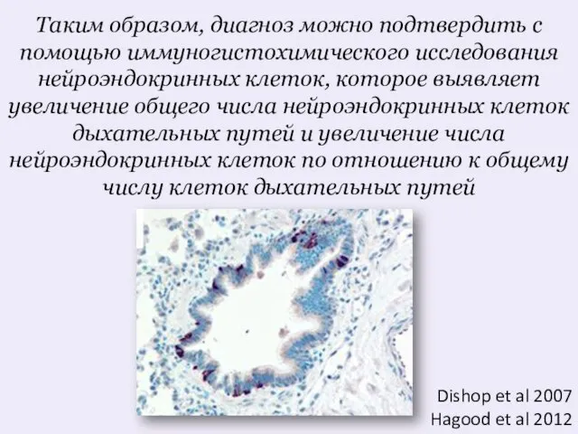 Таким образом, диагноз можно подтвердить с помощью иммуногистохимического исследования нейроэндокринных клеток,