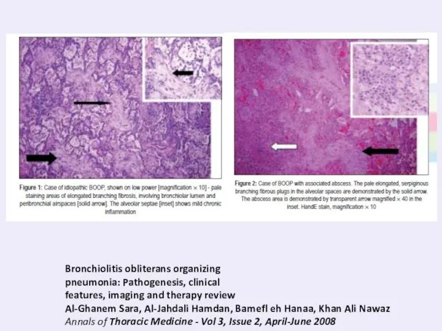 Bronchiolitis obliterans organizing pneumonia: Pathogenesis, clinical features, imaging and therapy review