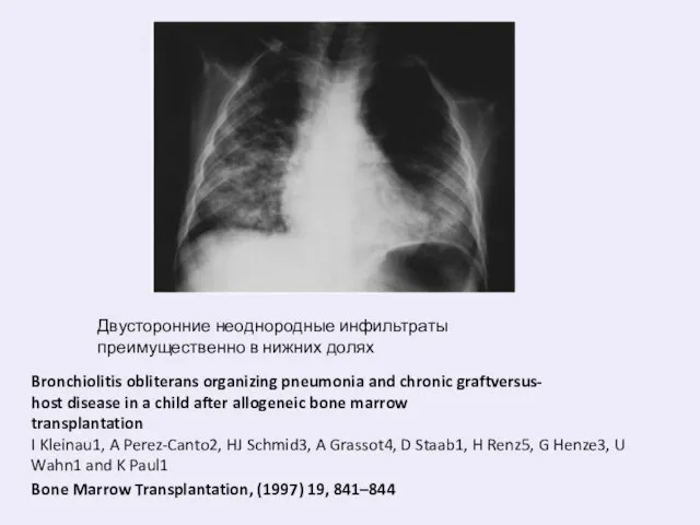 Двусторонние неоднородные инфильтраты преимущественно в нижних долях Bronchiolitis obliterans organizing pneumonia