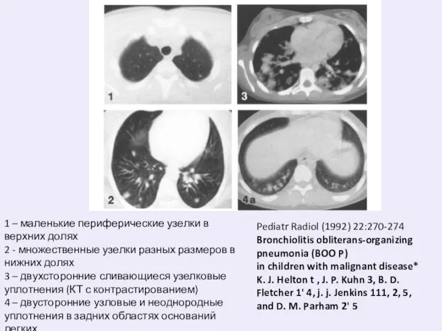 1 – маленькие периферические узелки в верхних долях 2 - множественные