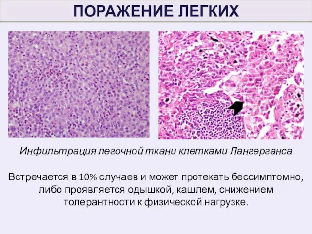 Встречается в 10% случаев и может протекать бессимптомно, либо проявляется одышкой,