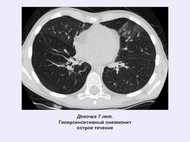Девочка 7 лет. Гиперсенситивный пневмонит острое течение