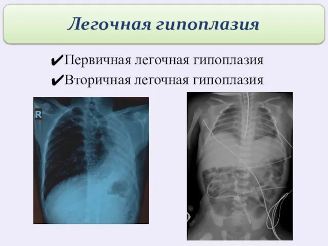 Первичная легочная гипоплазия Вторичная легочная гипоплазия