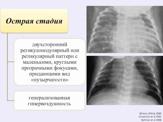 Wilson, Mikity 1960 Grossman et al 1965 Reittner et al 1998