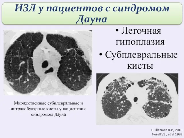 Множественные субплевральные и интралобулярные кисты у пациентов с синдромом Дауна Легочная