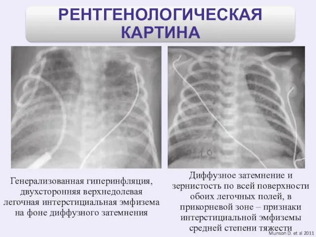 Munson D. et al 2011 Генерализованная гиперинфляция, двухсторонняя верхнедолевая легочная интерстициальная