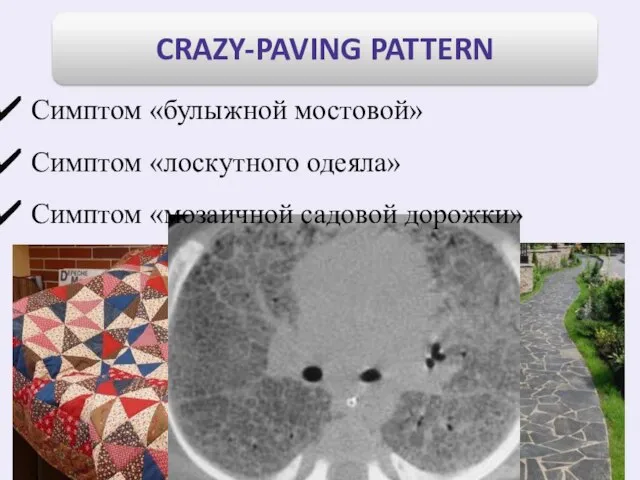 Симптом «булыжной мостовой» Симптом «лоскутного одеяла» Симптом «мозаичной садовой дорожки»