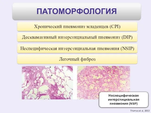 Неспецифическая интерстициальная пневмония (NSIP) Thomas et al, 2002