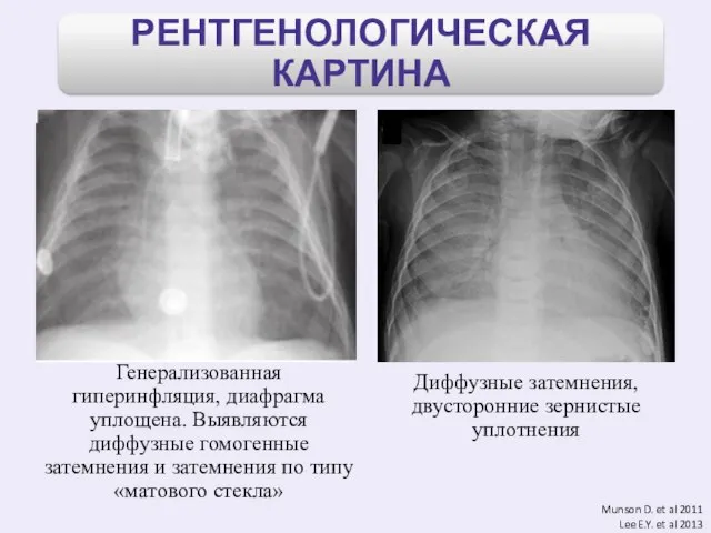 Munson D. et al 2011 Lee E.Y. et al 2013 Генерализованная