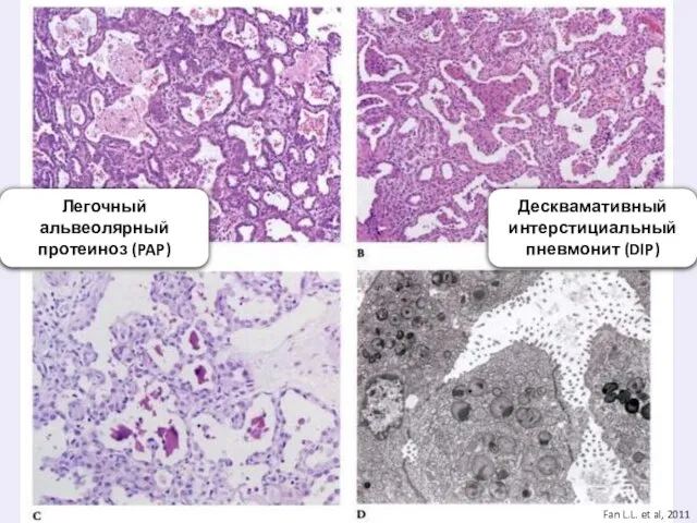 Легочный альвеолярный протеиноз (PAP) Десквамативный интерстициальный пневмонит (DIP) Fan L.L. et al, 2011